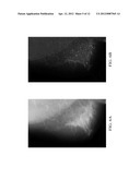 METHOD AND APPARATUS FOR ENHANCING REPRESENTATIONS OF MICRO-CALCIFICATIONS     IN A DIGITAL MAMMOGRAM IMAGE diagram and image