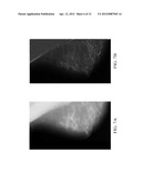 METHOD AND APPARATUS FOR ENHANCING REPRESENTATIONS OF MICRO-CALCIFICATIONS     IN A DIGITAL MAMMOGRAM IMAGE diagram and image