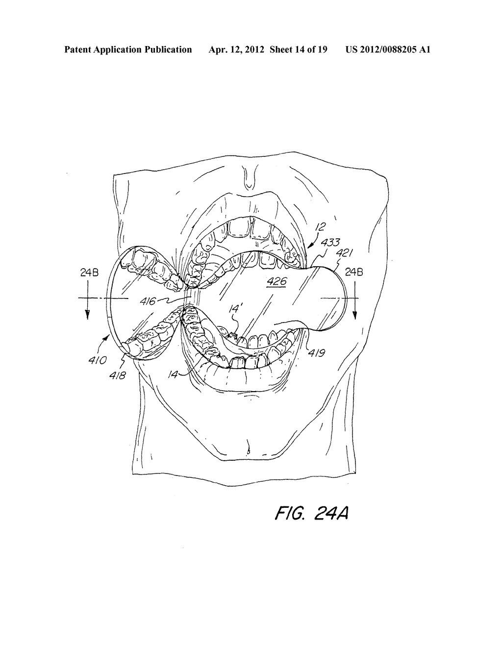 DENTAL BITE BLOCK - diagram, schematic, and image 15