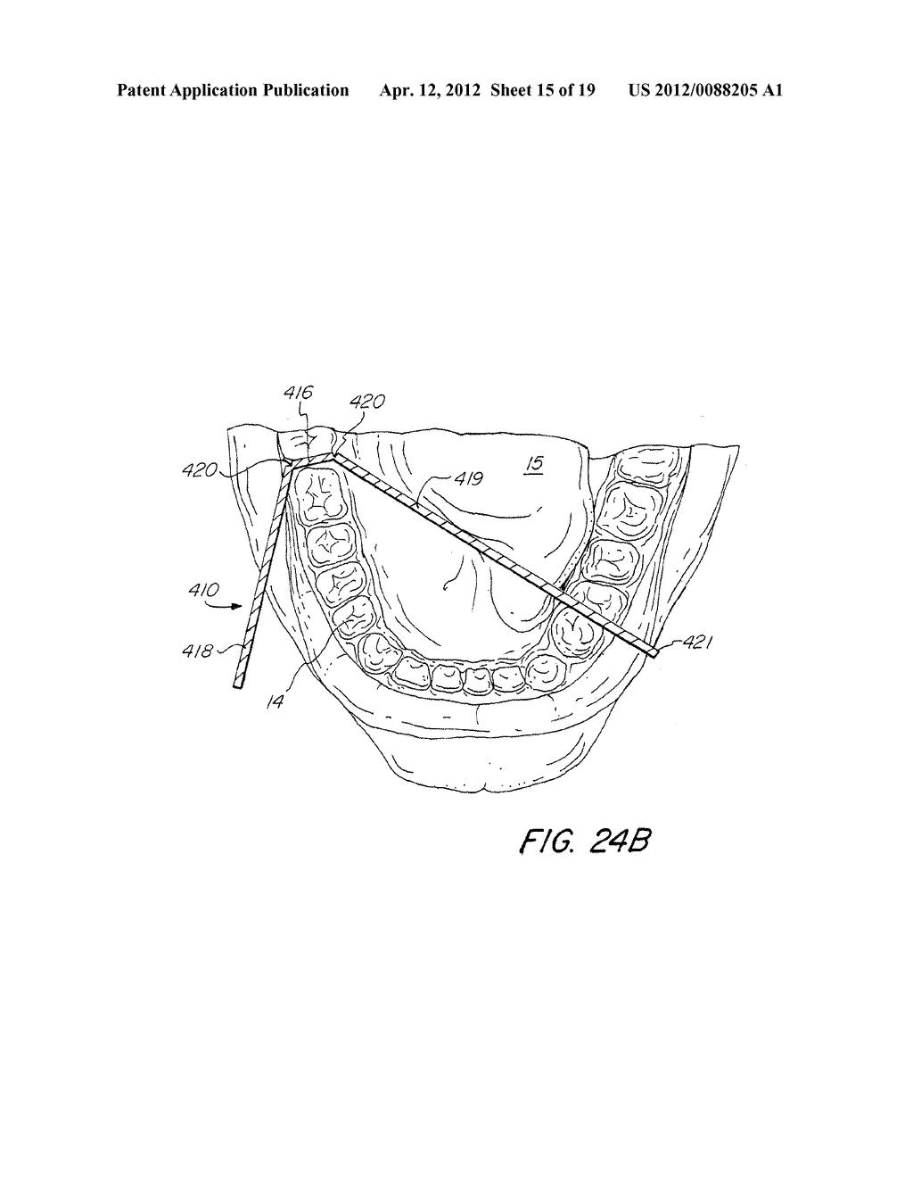 DENTAL BITE BLOCK - diagram, schematic, and image 16