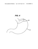 Methods and Devices for Placement of an Intra-Abdominal or Intra-Thoracic     Appliance Through a Natural Body Orifice diagram and image