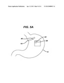 Methods and Devices for Placement of an Intra-Abdominal or Intra-Thoracic     Appliance Through a Natural Body Orifice diagram and image