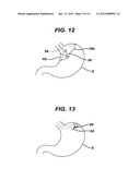 Methods and Devices for Placement of an Intra-Abdominal or Intra-Thoracic     Appliance Through a Natural Body Orifice diagram and image