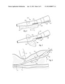 STABILIZED ELONGATE IMPLANTABLE VASCULAR ACCESS DEVICE diagram and image