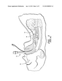 PARAMETER-SENSING ENDOTRACHEAL TUBE diagram and image