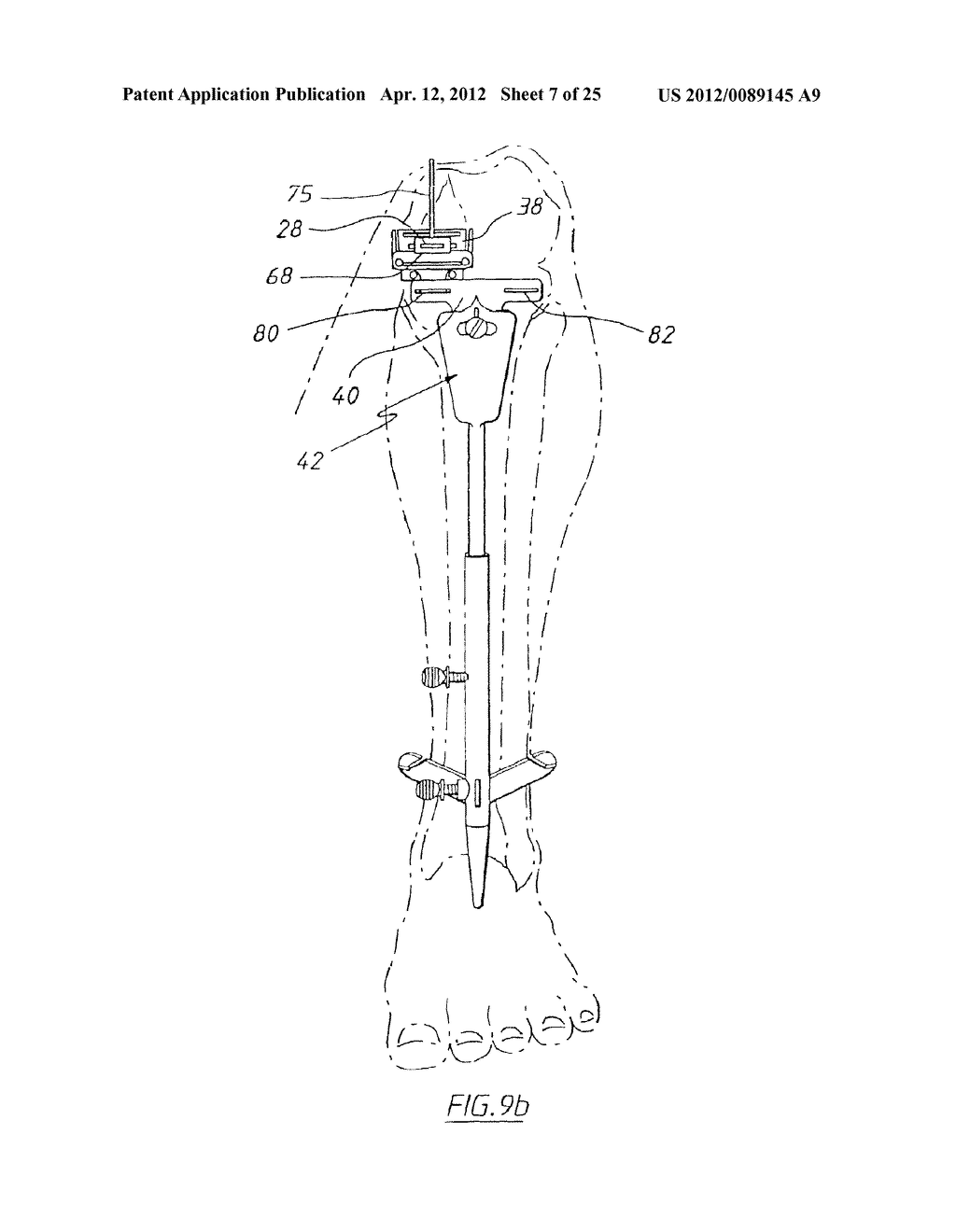 APPARATUS FOR USE IN ARTHROPLASTY ON A KNEE JOINT - diagram, schematic, and image 08