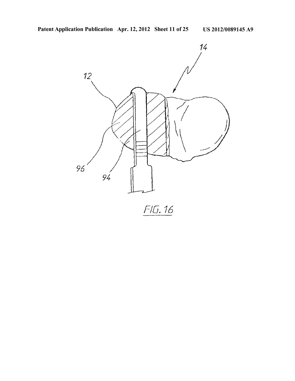 APPARATUS FOR USE IN ARTHROPLASTY ON A KNEE JOINT - diagram, schematic, and image 12