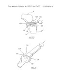 APPARATUS FOR USE IN ARTHROPLASTY ON A KNEE JOINT diagram and image
