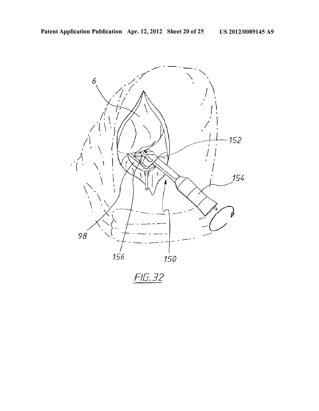 APPARATUS FOR USE IN ARTHROPLASTY ON A KNEE JOINT - diagram, schematic, and image 21