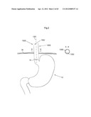 STOMACH INSTRUMENT AND METHOD diagram and image