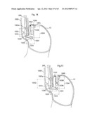 STOMACH INSTRUMENT AND METHOD diagram and image