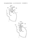 STOMACH INSTRUMENT AND METHOD diagram and image