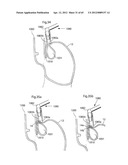 STOMACH INSTRUMENT AND METHOD diagram and image