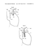 STOMACH INSTRUMENT AND METHOD diagram and image