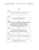 STOMACH INSTRUMENT AND METHOD diagram and image