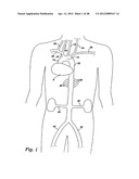 PARTIAL AORTIC OCCLUSION DEVICES AND METHODS FOR CEREBRAL PERFUSION     AUGMENTATION diagram and image