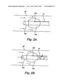 PARTIAL AORTIC OCCLUSION DEVICES AND METHODS FOR CEREBRAL PERFUSION     AUGMENTATION diagram and image