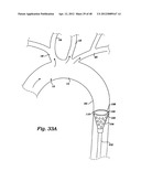 PARTIAL AORTIC OCCLUSION DEVICES AND METHODS FOR CEREBRAL PERFUSION     AUGMENTATION diagram and image