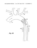 PARTIAL AORTIC OCCLUSION DEVICES AND METHODS FOR CEREBRAL PERFUSION     AUGMENTATION diagram and image