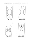 PARTIAL AORTIC OCCLUSION DEVICES AND METHODS FOR CEREBRAL PERFUSION     AUGMENTATION diagram and image