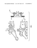 Rotatable Bone Plate diagram and image