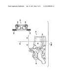 Rotatable Bone Plate diagram and image