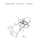 Fracture Fixation Device diagram and image