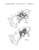 Fracture Fixation Device diagram and image