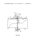 Fracture Fixation Device diagram and image