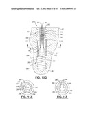 Fracture Fixation Device diagram and image