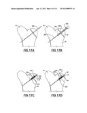 Fracture Fixation Device diagram and image