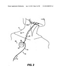 Obstructive Sleep Apnea Treatment Devices, Systems and Methods diagram and image