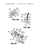 Obstructive Sleep Apnea Treatment Devices, Systems and Methods diagram and image