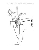 Obstructive Sleep Apnea Treatment Devices, Systems and Methods diagram and image