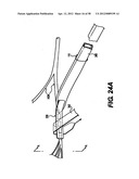 Obstructive Sleep Apnea Treatment Devices, Systems and Methods diagram and image