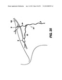 Obstructive Sleep Apnea Treatment Devices, Systems and Methods diagram and image