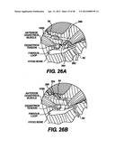 Obstructive Sleep Apnea Treatment Devices, Systems and Methods diagram and image