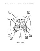 Obstructive Sleep Apnea Treatment Devices, Systems and Methods diagram and image