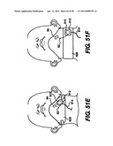 Obstructive Sleep Apnea Treatment Devices, Systems and Methods diagram and image