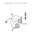 Obstructive Sleep Apnea Treatment Devices, Systems and Methods diagram and image