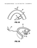 Obstructive Sleep Apnea Treatment Devices, Systems and Methods diagram and image