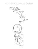 IMPLANT COMPONENTS AND METHODS diagram and image