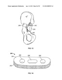 IMPLANT COMPONENTS AND METHODS diagram and image