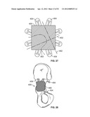 IMPLANT COMPONENTS AND METHODS diagram and image