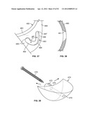 IMPLANT COMPONENTS AND METHODS diagram and image