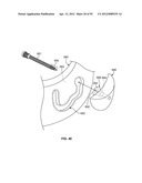 IMPLANT COMPONENTS AND METHODS diagram and image