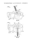 IMPLANT COMPONENTS AND METHODS diagram and image