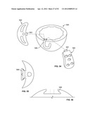 IMPLANT COMPONENTS AND METHODS diagram and image