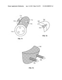 IMPLANT COMPONENTS AND METHODS diagram and image