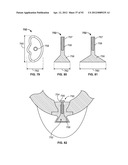 IMPLANT COMPONENTS AND METHODS diagram and image